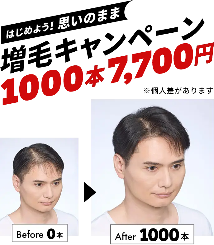 はじめよう！思いのまま増毛キャンペーン　1000本7,700円